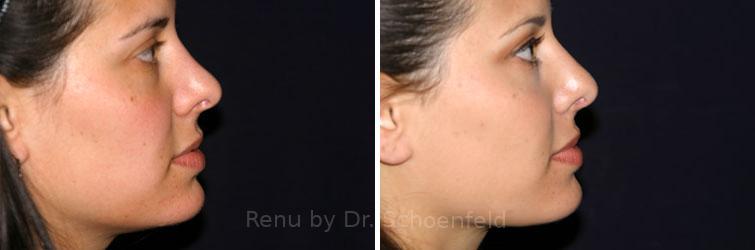 Revision Rhinoplasty Before and After Photos in DC, Patient 7546