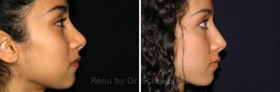 Revision Rhinoplasty Before and After Photos in DC, Patient 7551