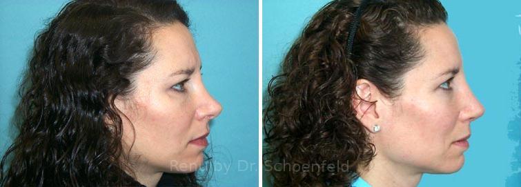 Revision Rhinoplasty Before and After Photos in DC, Patient 7554
