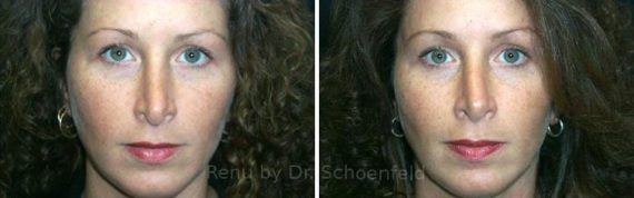 Revision Rhinoplasty Before and After Photos in DC, Patient 7559