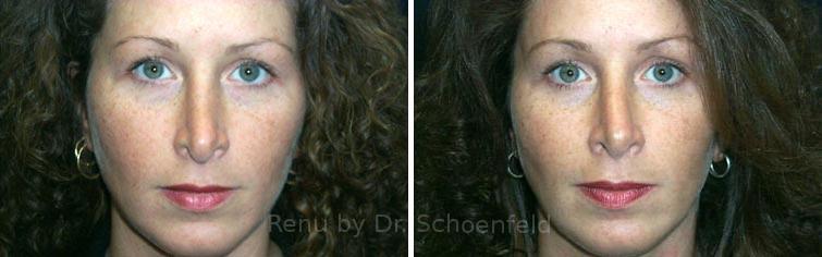 Revision Rhinoplasty Before and After Photos in DC, Patient 7559