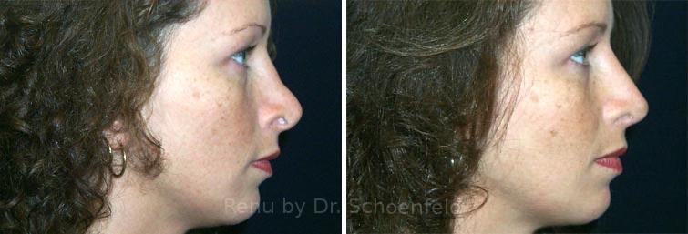 Revision Rhinoplasty Before and After Photos in DC, Patient 7559