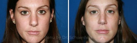 Revision Rhinoplasty Before and After Photos in DC, Patient 7564