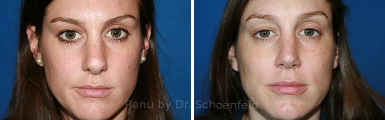 Revision Rhinoplasty Before and After Photos in DC, Patient 7564