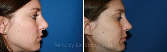 Revision Rhinoplasty Before and After Photos in DC, Patient 7564