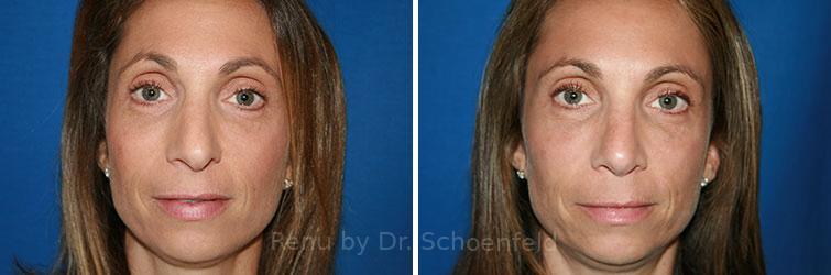 Revision Rhinoplasty Before and After Photos in DC, Patient 7569