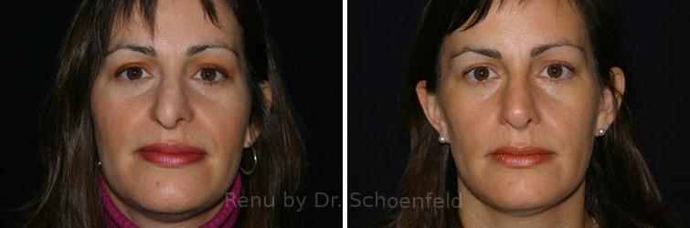 Revision Rhinoplasty Before and After Photos in DC, Patient 7536