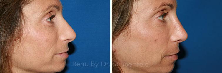 Revision Rhinoplasty Before and After Photos in DC, Patient 7569