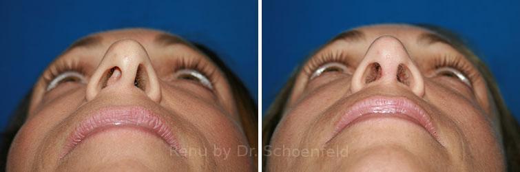 Revision Rhinoplasty Before and After Photos in DC, Patient 7569