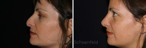 Revision Rhinoplasty Before and After Photos in DC, Patient 7536