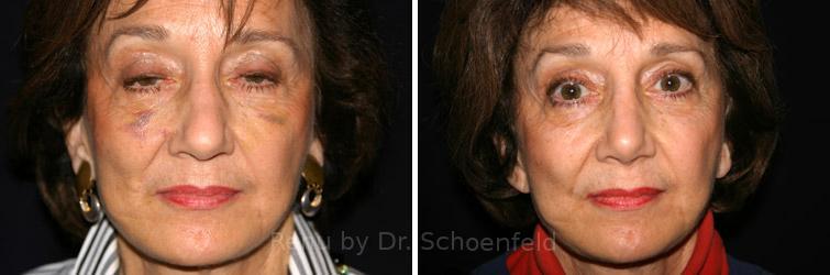 Revision Rhinoplasty Before and After Photos in DC, Patient 7541