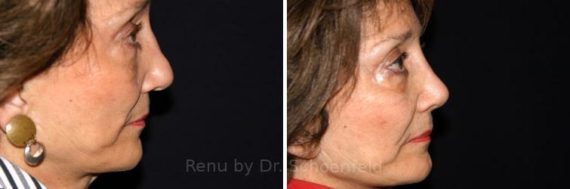 Revision Rhinoplasty Before and After Photos in DC, Patient 7541