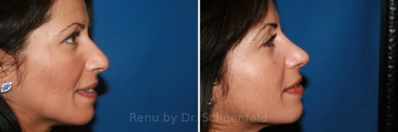 Rhinoplasty Before and After Photos in DC, Patient 7586