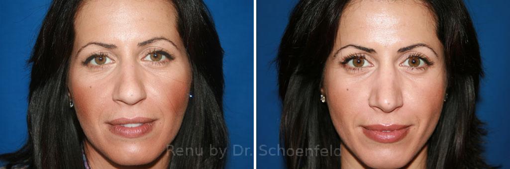 Rhinoplasty Before and After Photos in DC, Patient 7586