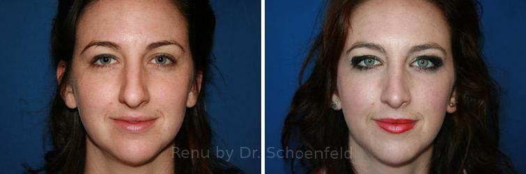 Rhinoplasty Before and After Photos in DC, Patient 7626