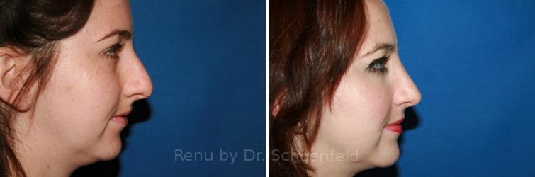 Rhinoplasty Before and After Photos in DC, Patient 7626