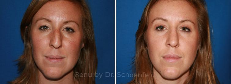 Rhinoplasty Before and After Photos in DC, Patient 7631