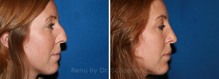 Rhinoplasty Before and After Photos in DC, Patient 7631