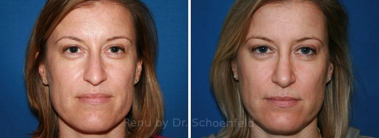 Rhinoplasty Before and After Photos in DC, Patient 7636