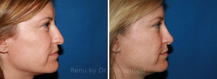 Rhinoplasty Before and After Photos in DC, Patient 7636