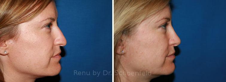 Patient 7636, Rhinoplasty Before and After Photos Rhinoplasty Before and After Photos in DC, Patient 7636