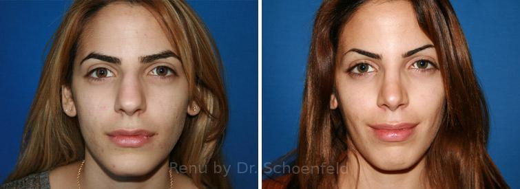 Rhinoplasty Before and After Photos in DC, Patient 7641