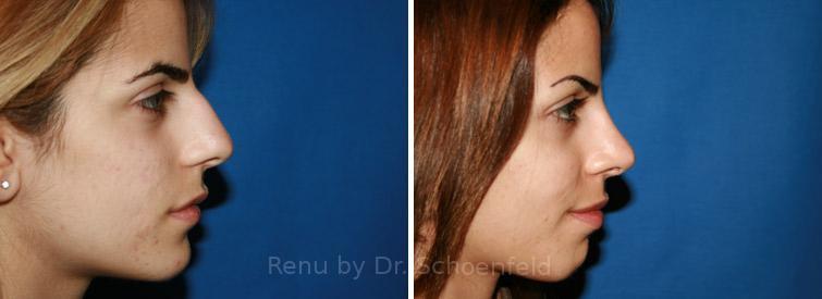 Rhinoplasty Before and After Photos in DC, Patient 7641