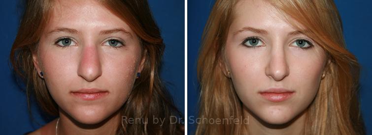 Patient 7646, Rhinoplasty Before and After Photos Rhinoplasty Before and After Photos in DC, Patient 7646