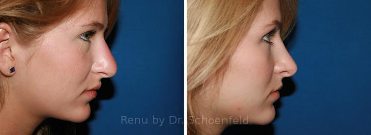 Patient 7646, Rhinoplasty Before and After Photos Rhinoplasty Before and After Photos in DC, Patient 7646