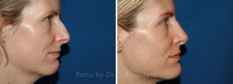 Rhinoplasty Before and After Photos in DC, Patient 7651