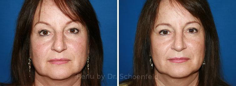 Rhinoplasty Before and After Photos in DC, Patient 7656