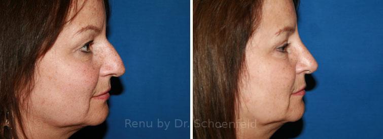 Rhinoplasty Before and After Photos in DC, Patient 7656