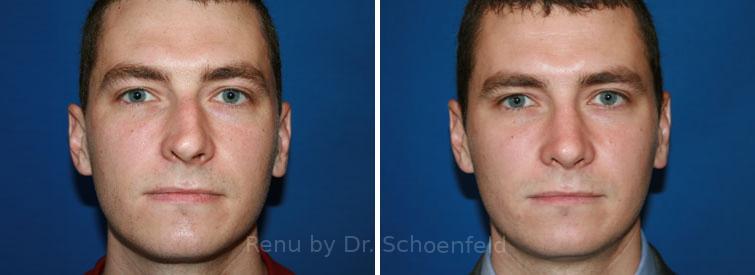 Rhinoplasty Before and After Photos in DC, Patient 7661
