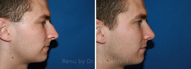 Rhinoplasty Before and After Photos in DC, Patient 7661