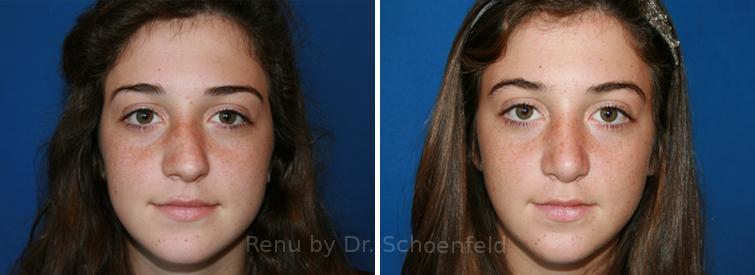 Patient 7666, Rhinoplasty Before and After Photos Rhinoplasty Before and After Photos in DC, Patient 7666