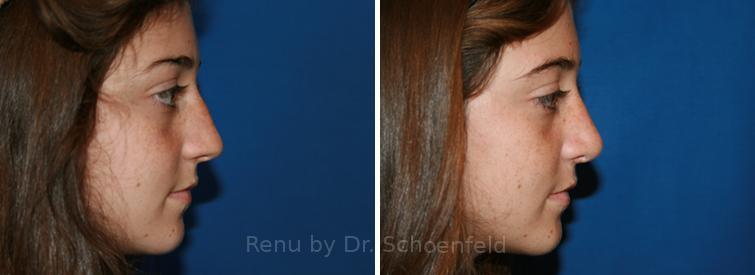 Patient 7666, Rhinoplasty Before and After Photos Rhinoplasty Before and After Photos in DC, Patient 7666