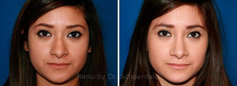 Rhinoplasty Before and After Photos in DC, Patient 7621