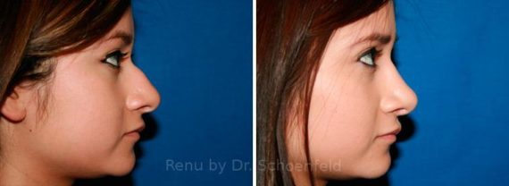 Rhinoplasty Before and After Photos in DC, Patient 7621