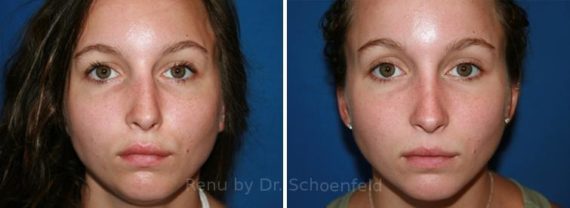 Rhinoplasty Before and After Photos in DC, Patient 7671