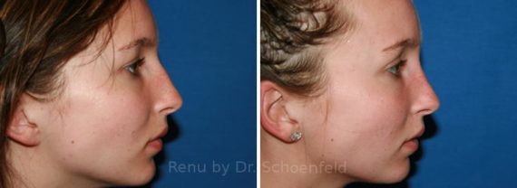 Rhinoplasty Before and After Photos in DC, Patient 7671
