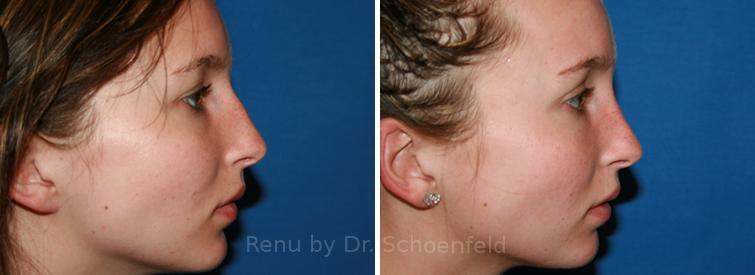 Rhinoplasty Before and After Photos in DC, Patient 7671