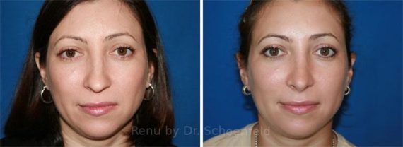 Rhinoplasty Before and After Photos in DC, Patient 7676