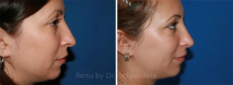 Rhinoplasty Before and After Photos in DC, Patient 7676