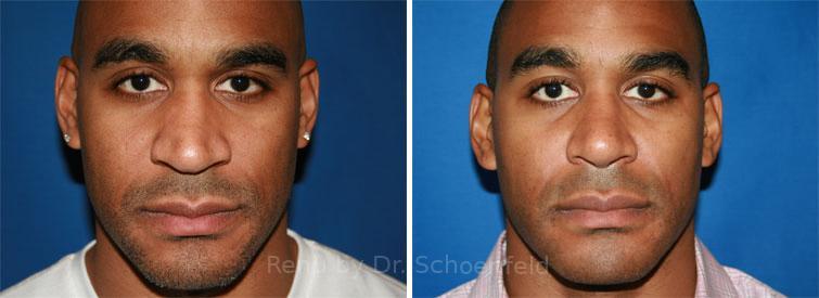 Rhinoplasty Before and After Photos in DC, Patient 7681