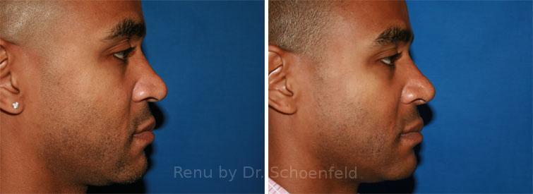 Rhinoplasty Before and After Photos in DC, Patient 7681