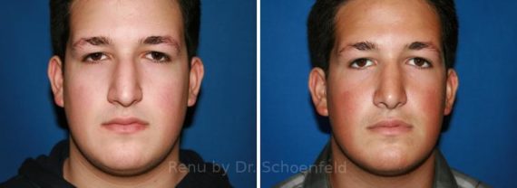 Rhinoplasty Before and After Photos in DC, Patient 7686