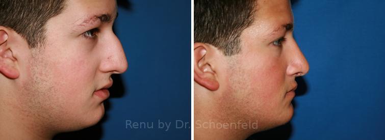Rhinoplasty Before and After Photos in DC, Patient 7686