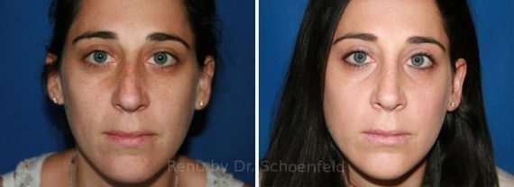 Rhinoplasty Before and After Photos in DC, Patient 7691