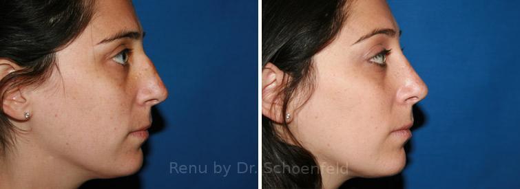 Rhinoplasty Before and After Photos in DC, Patient 7691