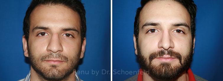 Patient 7696, Rhinoplasty Before and After Photos Rhinoplasty Before and After Photos in DC, Patient 7696